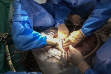 The First Simultaneous Heart-Liver Transplantation in Poland 