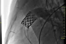 zabieg przezcewnikowej implantacji zastawki pnia płucnego