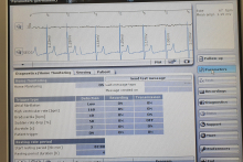 First in Poland implantation of the state-of-the-art tool for arrhythmia detection in a child