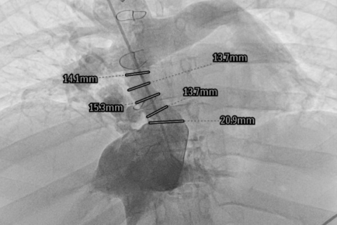 Chest X-ray showing the Fontan tunnel and metal surgical staples.